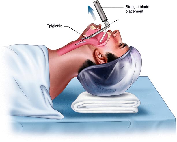 Direct laryngoscopy